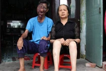 Chuyện tình cảm động của ông lão ăn xin có khuôn mặt biến dạng