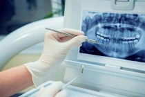 Cô gái 26 tuổi vĩnh biệt 11 chiếc răng cùng lúc