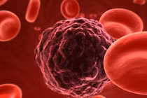 Đi tiểu thấy có dấu hiệu này,cẩn thận tín hiệu cảnh báo ung thư