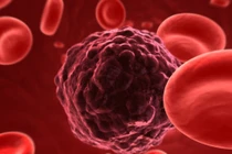 Đi tiểu thấy có dấu hiệu này,cẩn thận tín hiệu cảnh báo ung thư