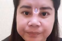 Rùng rợn với những ca nâng mũi hỏng, lòi sụn giả