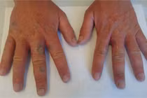 Chàng trai hóa zombie vì nước chanh và "mặt trời nửa đêm"