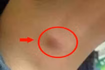 1 chậm, 2 lồi, 3 nhiều xuất hiện trên cơ thể cảnh báo phổi rất yếu