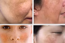 Hậu quả khủng khiếp của quý bà đi chữa nám da bằng ... axit