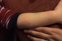 Không nghe lời, cậu học sinh bị cô giáo cắn đỏ tay