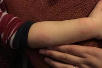 Không nghe lời, cậu học sinh bị cô giáo cắn đỏ tay