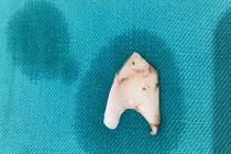 Hóc xương thủ lợn, nam thanh niên bị rách thực quản suýt chết