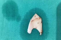 Hóc xương thủ lợn, nam thanh niên bị rách thực quản suýt chết