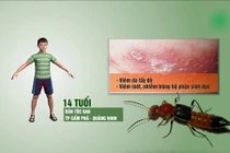 Video: Thiếu niên bị loét vùng kín do dùng rượu ngâm kiến ba khoang