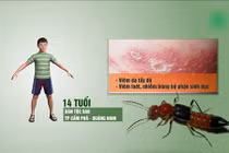 Video: Thiếu niên bị loét vùng kín do dùng rượu ngâm kiến ba khoang