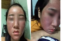 Những loại kem dưỡng trắng hủy hoại da không kém gì kem trộn