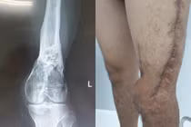 Bác sĩ kể lại hành trình 5 năm cứu chân chàng trai thối mủn lủng lẳng