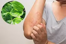 9 loại lá tắm hết dị ứng, nổi mề đay ngứa ngáy khi trời lạnh