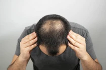 Phát hiện mới về cách điều trị hói đầu cho nam giới