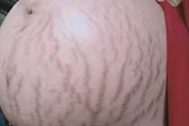 Dân mạng ném đá chồng chê bụng bầu rạn của vợ là "ghê thật" 