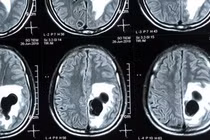 Liệt nửa người, não có 5 tổ sán do món "khoái khẩu" tiết canh