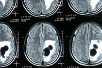 Liệt nửa người, não có 5 tổ sán do món "khoái khẩu" tiết canh