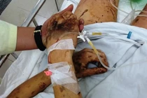 Vụ Việt kiều Canada bị tạt axit, cắt gân chân: Hung thủ vẫn bí ẩn