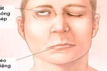 Thời tiết chuyển lạnh: Thức đêm nhiều cẩn thận kẻo méo miệng, lệch mặt