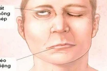 Thời tiết chuyển lạnh: Thức đêm nhiều cẩn thận kẻo méo miệng, lệch mặt