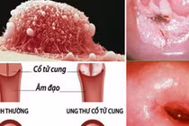 Yêu từ năm 16 tuổi khiến cô gái mắc ung thư cổ tử cung