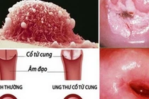 Yêu từ năm 16 tuổi khiến cô gái mắc ung thư cổ tử cung