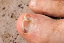 5 dấu hiệu trên bàn chân cảnh báo người tuổi thọ ngắn