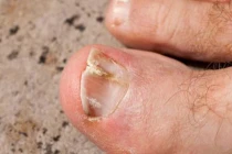 5 dấu hiệu trên bàn chân cảnh báo người tuổi thọ ngắn