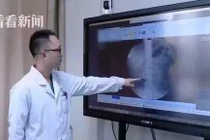 Bé trai 9 tuổi có 56 viên sỏi trong thận vì thói quen ăn uống này