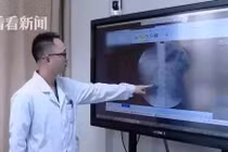 Bé trai 9 tuổi có 56 viên sỏi trong thận vì thói quen ăn uống này