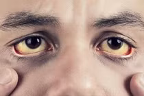 Video: Triệu chứng bất thường ở mắt không nên bỏ qua