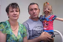 Dị tật lạ khiến bé gái chào đời với nửa khuôn mặt