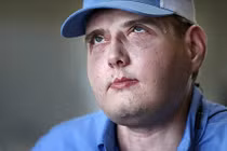 Ghép mặt thành công cho người đàn ông bị bỏng nặng