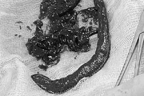 Nội soi phát hiện con vật kinh dị trong bàng quang