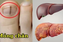 4 dấu hiệu ở bàn chân cảnh báo chức năng gan suy giảm