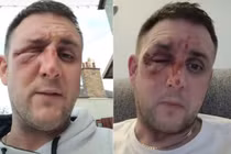 Bỏng mặt vì nấu ăn theo hướng dẫn của TikTok