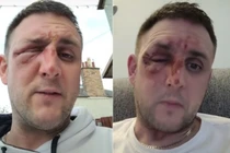 Bỏng mặt vì nấu ăn theo hướng dẫn của TikTok