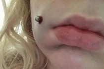 Tạo lúm đồng tiền, cô gái bị chảy máu 4 ngày do nhiễm trùng nặng