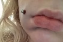 Tạo lúm đồng tiền, cô gái bị chảy máu 4 ngày do nhiễm trùng nặng