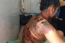 Thanh Hóa: Dội nước sôi vào vợ rồi thản nhiên bỏ đi