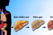 2 thói quen khi thức dậy buổi sáng hại gan hơn uống bia rượu