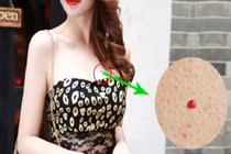 Nốt ruồi son ở 5 vị trí này báo hiệu cuộc sống sung túc