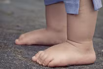 Bàn chân bẹt: Dấu hiệu dị tật không thể chủ quan