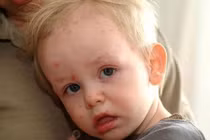 Mẹo dân gian trị rôm sảy cho trẻ sơ sinh cực nhanh khỏi