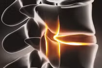 Ngủ võng thường xuyên, cụ bà U.70 suýt bị tàn phế