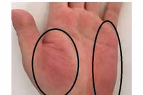 Dấu hiệu trên tay cảnh báo sớm ung thư gan