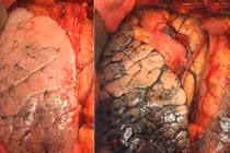 Mỗi người chi 2,7 triệu mỗi năm để "mua" bệnh ung thư