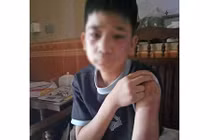 Bé trai 14 tuổi bị bố đẻ mẹ kế bạo hành