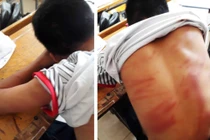 Tình tiết mới vụ nam sinh lớp 8 bị bố đánh dã man phải nhập viện