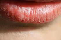 Người có gan xấu thường có 4 biểu hiện trên môi
